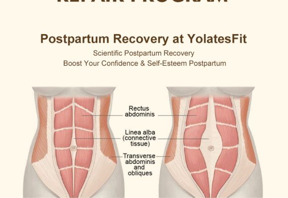 Postpartum Rectus tear Abdominis Tear Repair