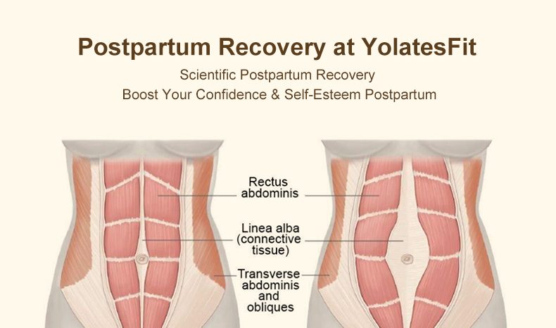 Postpartum Rectus tear Abdominis Tear Repair